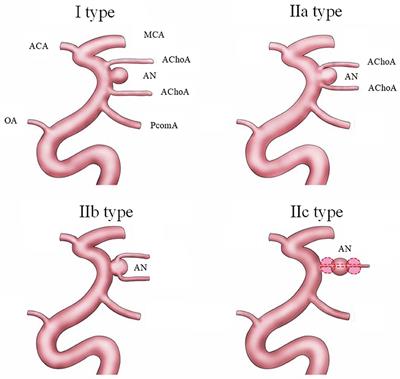 A New Classification of Anterior Choroidal Artery Aneurysms and Its Clinical Application